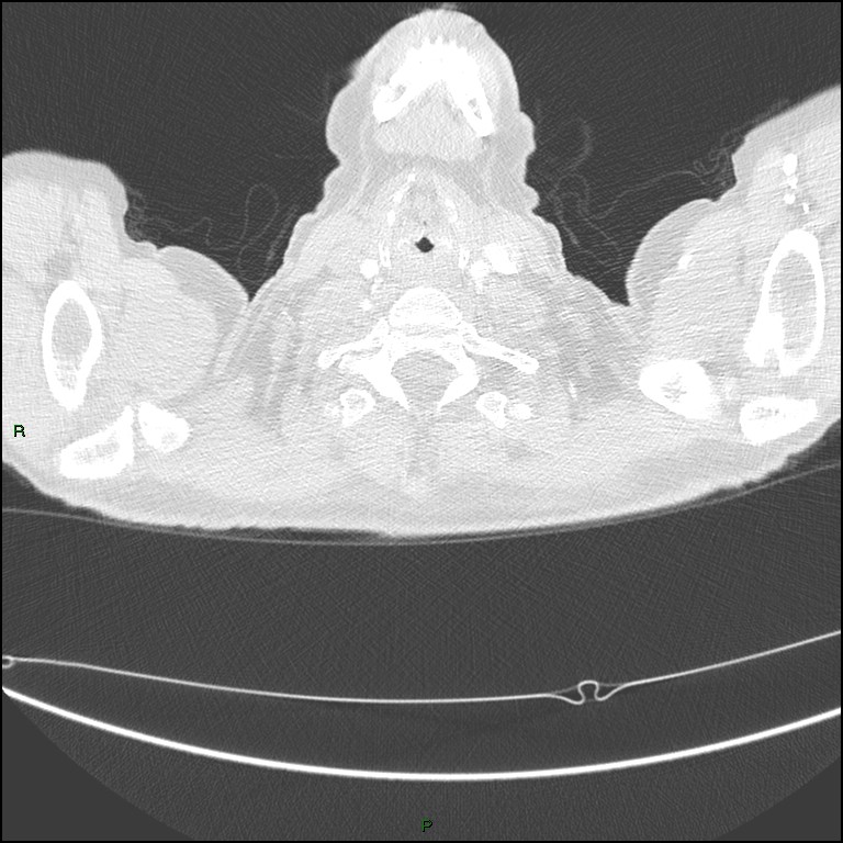 Cannonball metastases (Radiopaedia 82110-96150 Axial lung window 8).jpg
