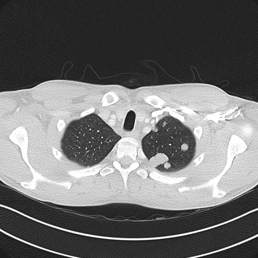 Cannonball metastases - testicular choriocarcinoma (Radiopaedia 84510-99891 Axial lung window 17).jpg