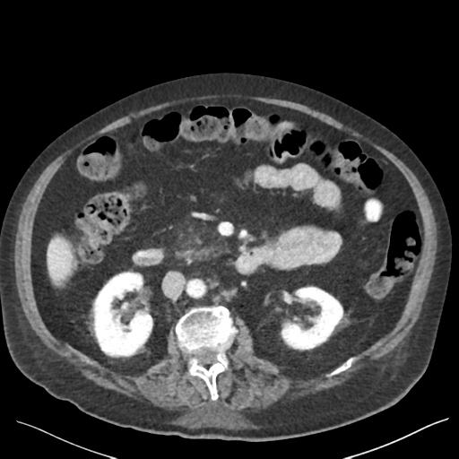 Cannonball metastases from endometrial cancer (Radiopaedia 42003-45031 E 34).png