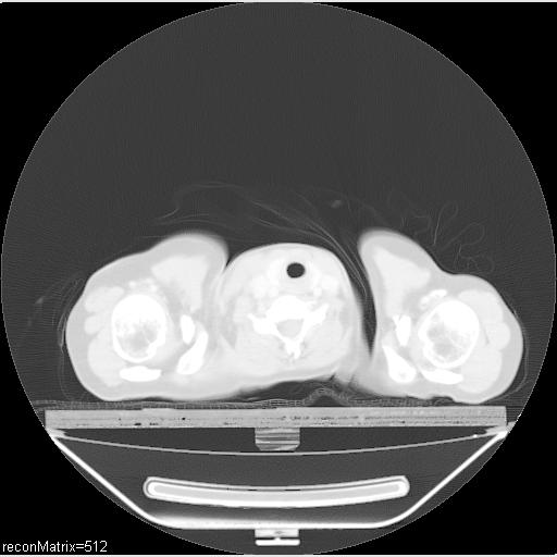 File:Carcinoma of esophagus (Radiopaedia 27356-27550 Axial lung window 34).jpg