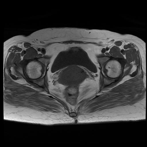 File:Carcinoma of the cervix (Radiopaedia 89018-105858 Axial T1 12).jpg
