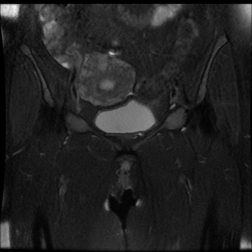 File:Carcinoma of the cervix (Radiopaedia 89018-105858 Coronal T2 fat sat 4).jpg