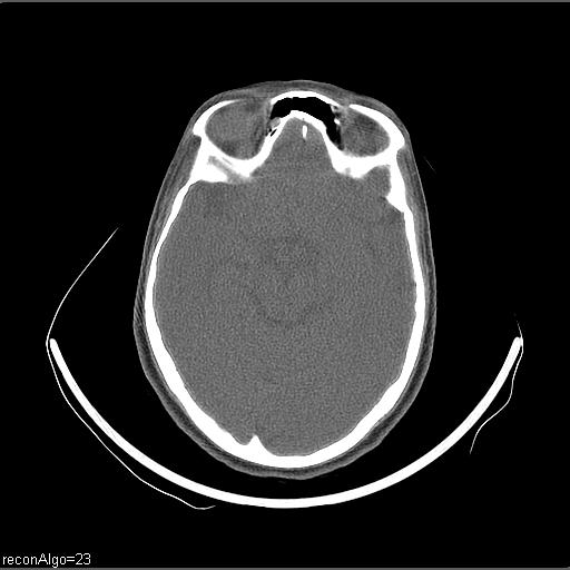 Carcinoma of the maxillary antrum (Radiopaedia 53805-59888 Axial non-contrast 79).jpg