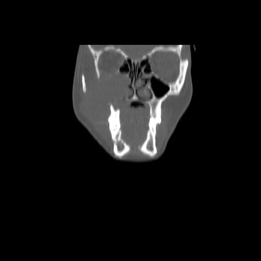 Carcinoma of the maxillary antrum (Radiopaedia 53805-59888 Coronal bone window 34).jpg