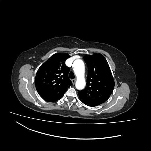 File:Cardiac hydatid disease (Radiopaedia 64684-73611 Axial with contrast 13).jpg