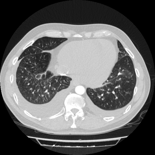 File:Cardiac tamponade (Radiopaedia 78607-91368 Axial lung window 69).jpg
