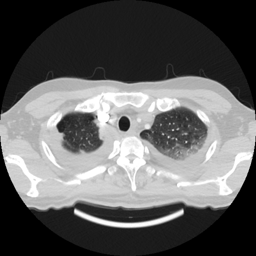 Cardiac tamponade (Radiopaedia 78607-91368 Axial lung window 7).jpg
