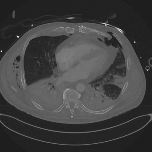 Cardiac trauma (Radiopaedia 32874-33858 Axial bone window 58).jpg