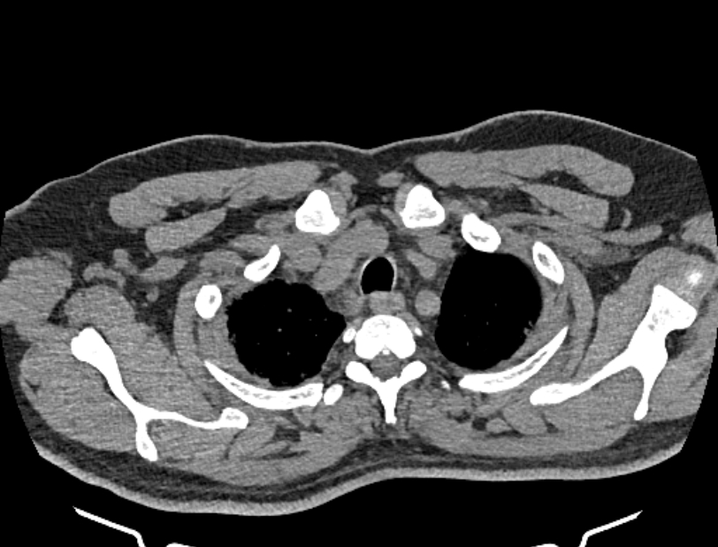 Cardiogenic pulmonary edema (Radiopaedia 68180-77678 Axial non-contrast 4).jpg