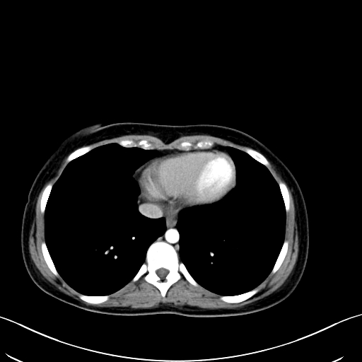 Caroli disease with medullary sponge kidney (Radiopaedia 82622-96804 C 9).jpg