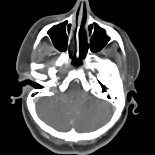Carotico ophthalmic aneurysm (Radiopaedia 42916-46148 A 43).png