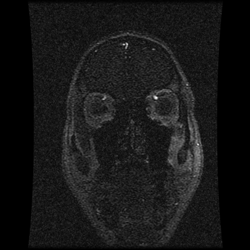 Carotid arterial dissection with acute cerebral infarction (Radiopaedia 26636-26784 MRV 134).jpg