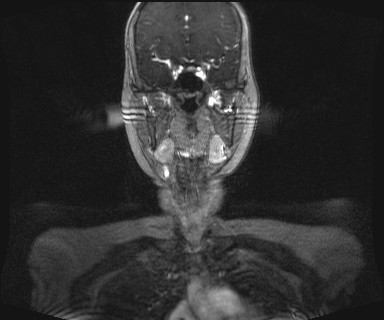 Carotid body tumor (Radiopaedia 12777-12912 MRA 19).jpg