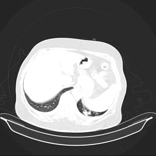 File:Carotid body tumor (Radiopaedia 21021-20948 Axial lung window 43).jpg