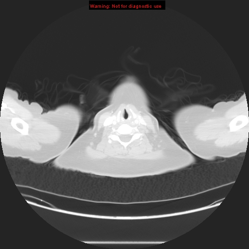 Carotid body tumor with lung metastases (Radiopaedia 9301-48390 Axial lung window 2).jpg