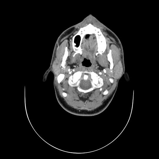 File:Carotid bulb pseudoaneurysm (Radiopaedia 57670-64616 A 10).jpg