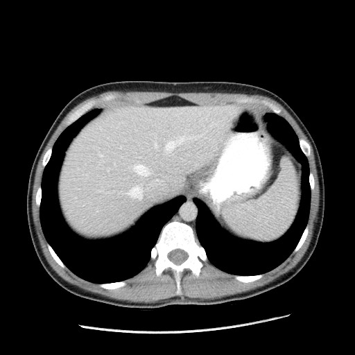 Castleman disease with fibrous pseudotumor in the abdomen (Radiopaedia 77296-89373 A 20).jpg