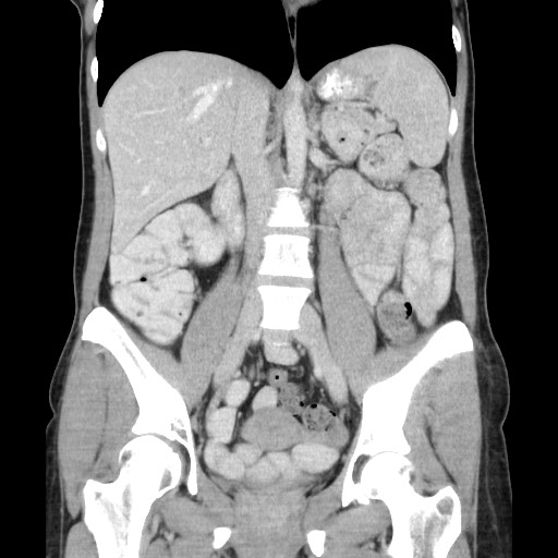 File:Castleman disease with fibrous pseudotumor in the abdomen (Radiopaedia 77296-89373 B 51).jpg