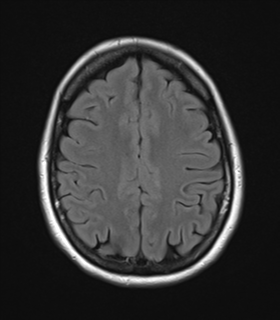 File:Cavernoma with bleed - midbrain (Radiopaedia 54546-60774 Axial FLAIR 23).png