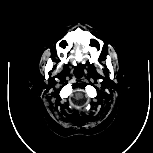 Cavernous hemangioma of the cerebellar falx (Radiopaedia 73025-83723 Axial non-contrast 2).jpg
