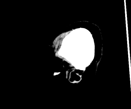 Cavernous hemangioma of the cerebellar falx (Radiopaedia 73025-83723 B 307).jpg