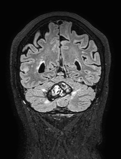 Cavernous hemangioma of the cerebellar falx (Radiopaedia 73025-83724 Coronal FLAIR 264).jpg