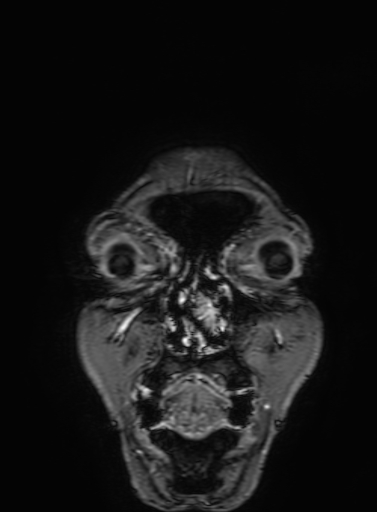 Cavernous hemangioma of the cerebellar falx (Radiopaedia 73025-83724 Coronal T1 C+ 15).jpg