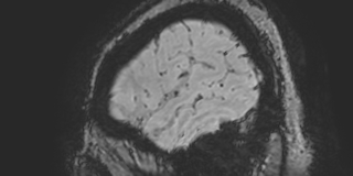 File:Cavernous hemangioma of the cerebellar falx (Radiopaedia 73025-83724 Sagittal BOLD 20).jpg