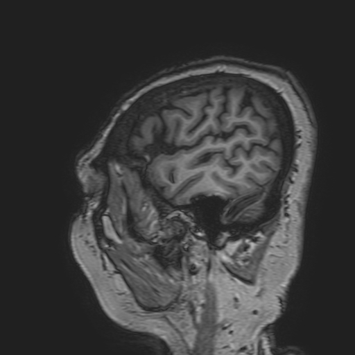 File:Cavernous hemangioma of the cerebellar falx (Radiopaedia 73025-83724 Sagittal T1 32).jpg