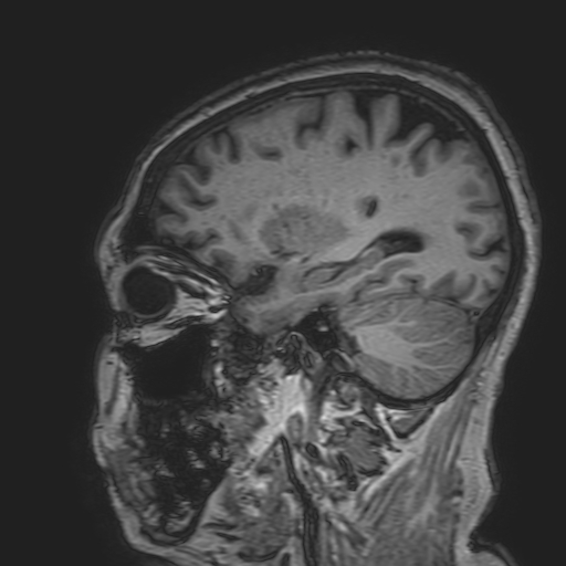 File:Cavernous hemangioma of the cerebellar falx (Radiopaedia 73025-83724 Sagittal T1 66).jpg