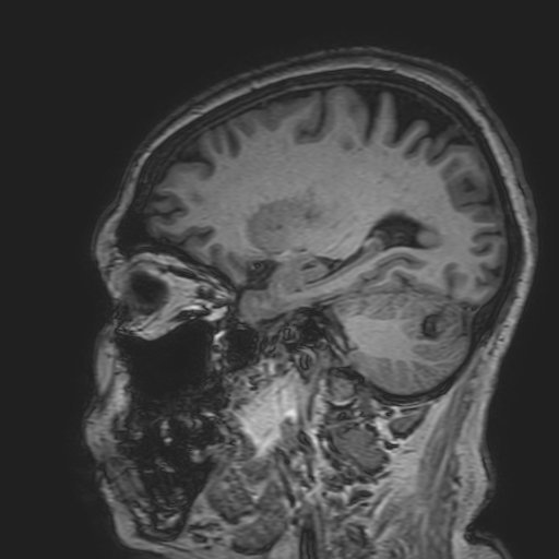 File:Cavernous hemangioma of the cerebellar falx (Radiopaedia 73025-83724 Sagittal T1 70).jpg