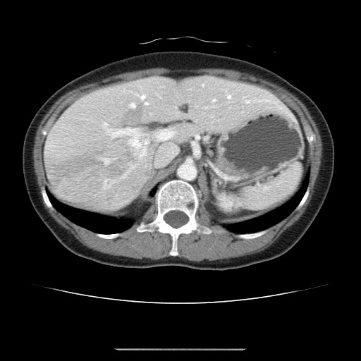 Cavernous hepatic hemangioma (Radiopaedia 75441-86667 B 33).jpg