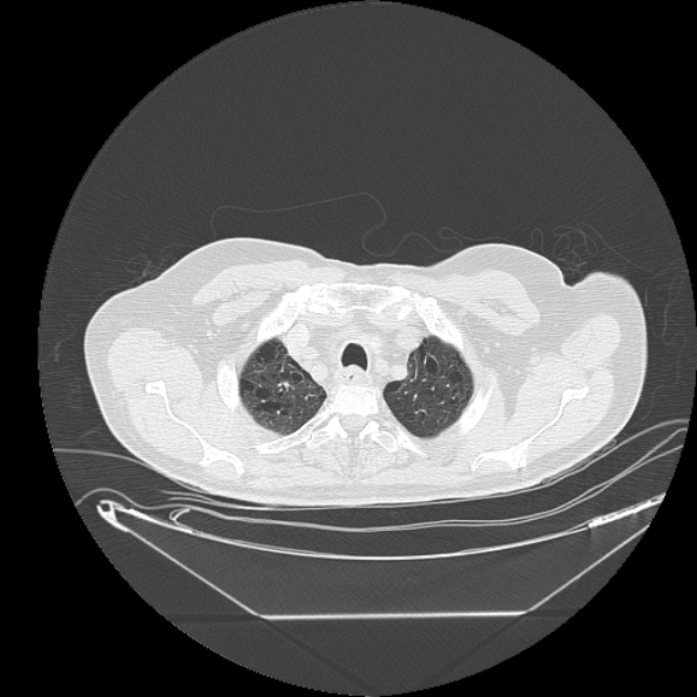 Cavitating bronchogenic carcinoma (Radiopaedia 44489-48162 Axial lung window 7).jpg
