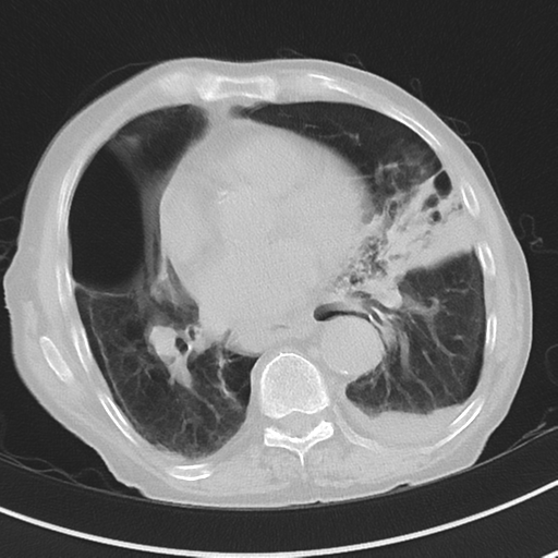 Cavitating pneumonia - lingular segments (Radiopaedia 34386-35678 Axial lung window 37).png
