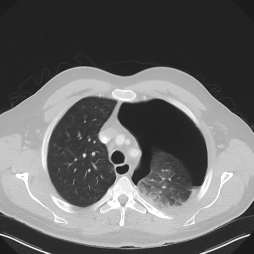 File:Cavitating pneumonia complicated by pneumothorax (Radiopaedia 48149-52994 Axial lung window 18).png