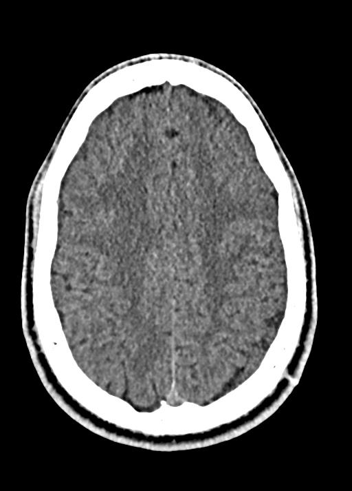 Cavum septum pellucidum and cavum vergae (Radiopaedia 77797-90060 Axial Brain Window 77).jpg