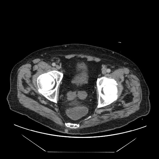 Cecal adenocarcinoma (Radiopaedia 64871-73817 A 89).jpg