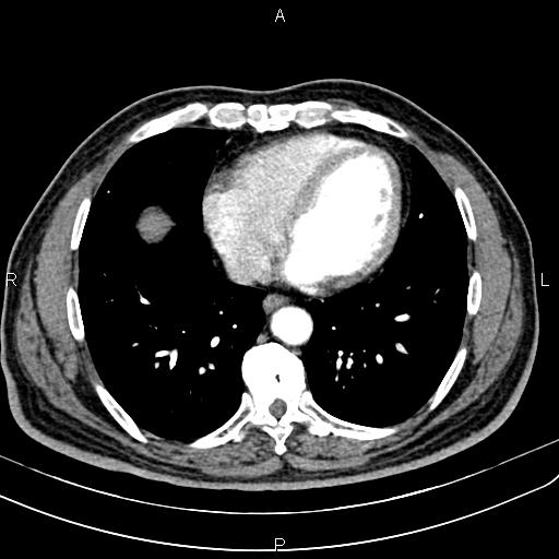 File:Cecal cancer with appendiceal mucocele (Radiopaedia 91080-108651 A 46).jpg
