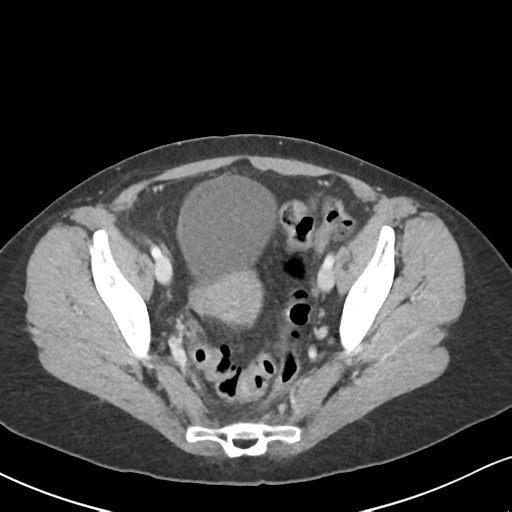 Cecal internal hernia through the foramen of Winslow (Radiopaedia 44820-48651 B 64).png