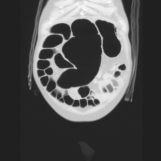 Cecal volvulus (Radiopaedia 75378-86620 Coronal lung window 32).jpg