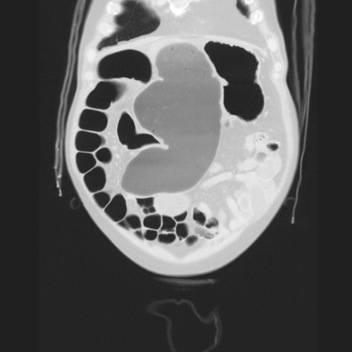 Cecal volvulus (Radiopaedia 75378-86620 Coronal lung window 37).jpg