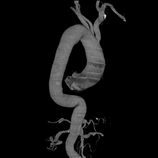 File:Celiac artery aneurysm (Radiopaedia 21574-21525 C 11).JPEG