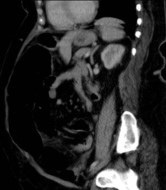 File:Celiac artery compression syndrome (Radiopaedia 24287-24570 A 1).jpg