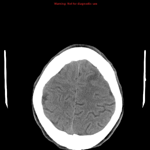 File:Central nervous system vasculitis (Radiopaedia 8410-9234 Axial non-contrast 23).jpg