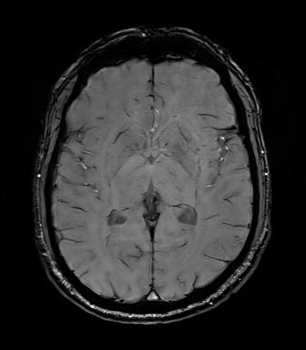 Central neurocytoma (Radiopaedia 71068-81303 Axial SWI 32).jpg