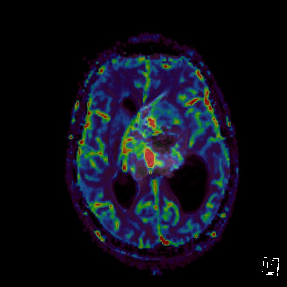 Central neurocytoma (Radiopaedia 84497-99872 Axial Perfusion 147).jpg