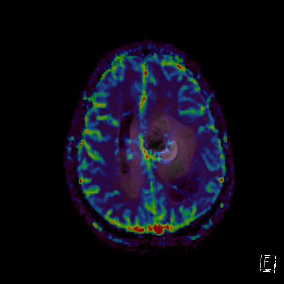 Central neurocytoma (Radiopaedia 84497-99872 Axial Perfusion 96).jpg