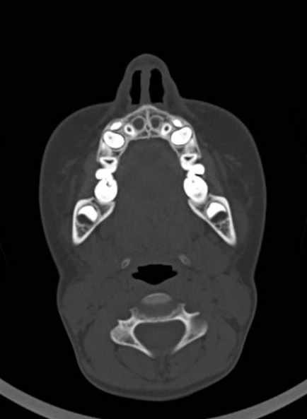 Cerebellar abscess (Radiopaedia 73727-84527 Axial bone window 6).jpg