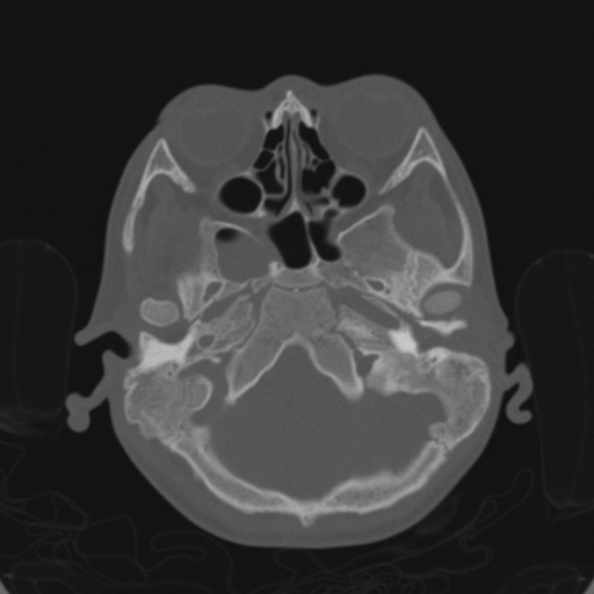 Cerebellar abscess secondary to mastoiditis (Radiopaedia 26284-26413 Axial bone window 38).jpg