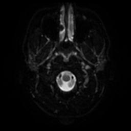 Cerebellar hemangioblastoma (Radiopaedia 29570-30077 Axial DWI 29).jpg